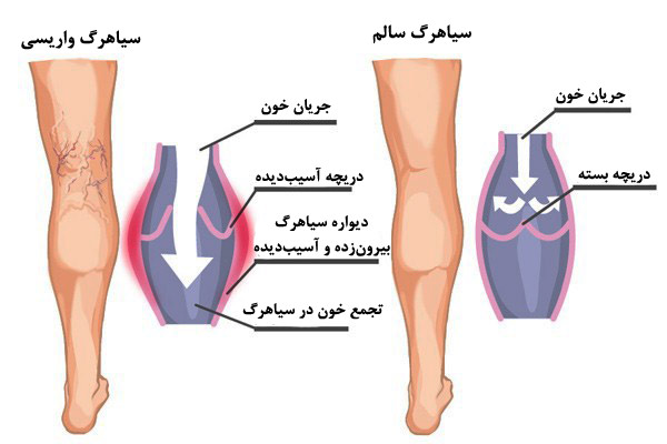 درمان جراحی واریس و عروق تار عنکبوتی پا