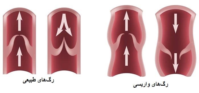 ارتباط تخریب دریچه لانه کبوتری و واریس