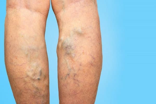 علائم مشابه واریس و سندرم پای بیقرار