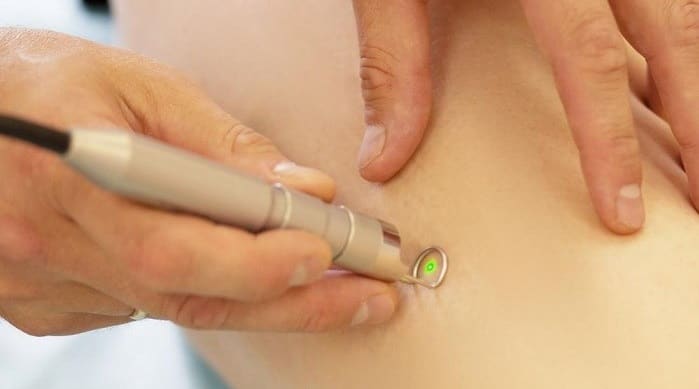 لیزردرمانی برای درمان سندروم کلیپل ترنونه